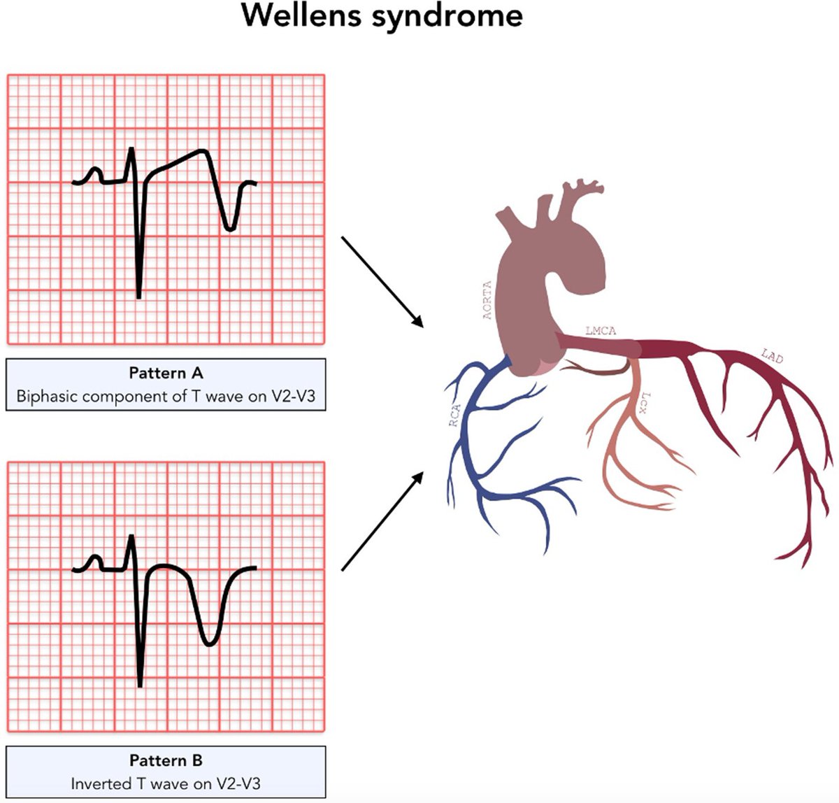 Wellens syndrome 😍
