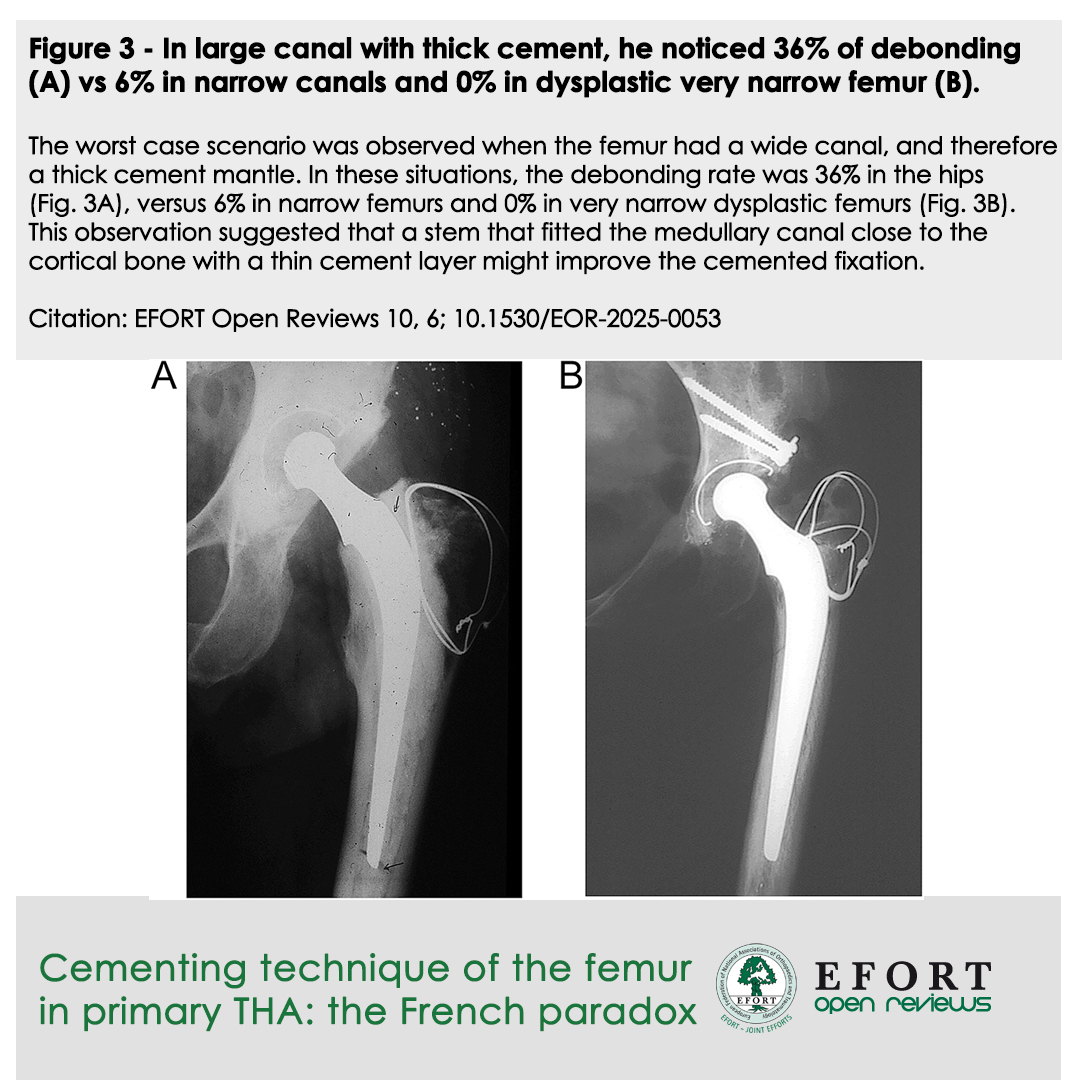 #EOR article: "French paradox" cementing technique for #THA 🇫🇷🦵
Uses thin cement, polished stem ✨
Key: cancellous bone removal 🦴
Results: Extremely low #PFF rates 
📊stable fixation, no subsidence. A method of choice! 
🔗 bit.ly/EOR250605
#HipReplacement #EFORT