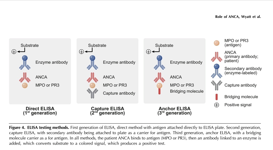 IamGopambuj's tweet photo. 🧪🧪ANCAs in details. 
The history , the pattern, their role in pathogenesis of vasculitis , the testing methods and role in prognosis. 
Excellent article @asnpublications @JASN_News 
https://t.co/fBiTQ7SIKO

#ANCA #NephX #MedTwitter #Immunology #BuddingNephros #GSR https://t.co/Q19vMWipnZ