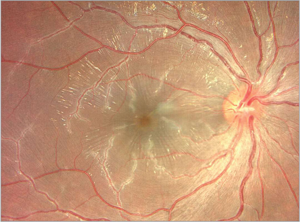 IMAGES in #Ophthalmology: 

Figure 2. Color photography of the right macula shows a frosted branch appearance to the retinal veins.

Read more for FREE: tinyurl.com/acyj45js

#ophthalmology #retina