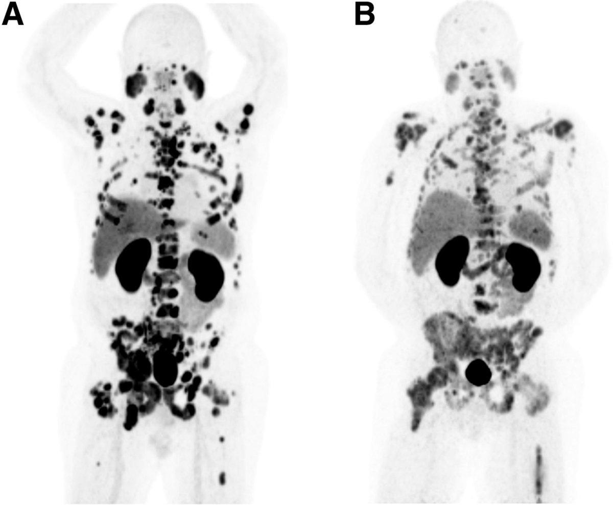 JournalofNucMed's tweet image. Continuing education: Treatment response evaluation in prostate cancer using PSMA PET/CT. ow.ly/uUgP50WocwV 

#NuclearMedicine #RPTherapy #ProstateCancer @liljasolnes @FrancescoCeci13 @DrAGafita