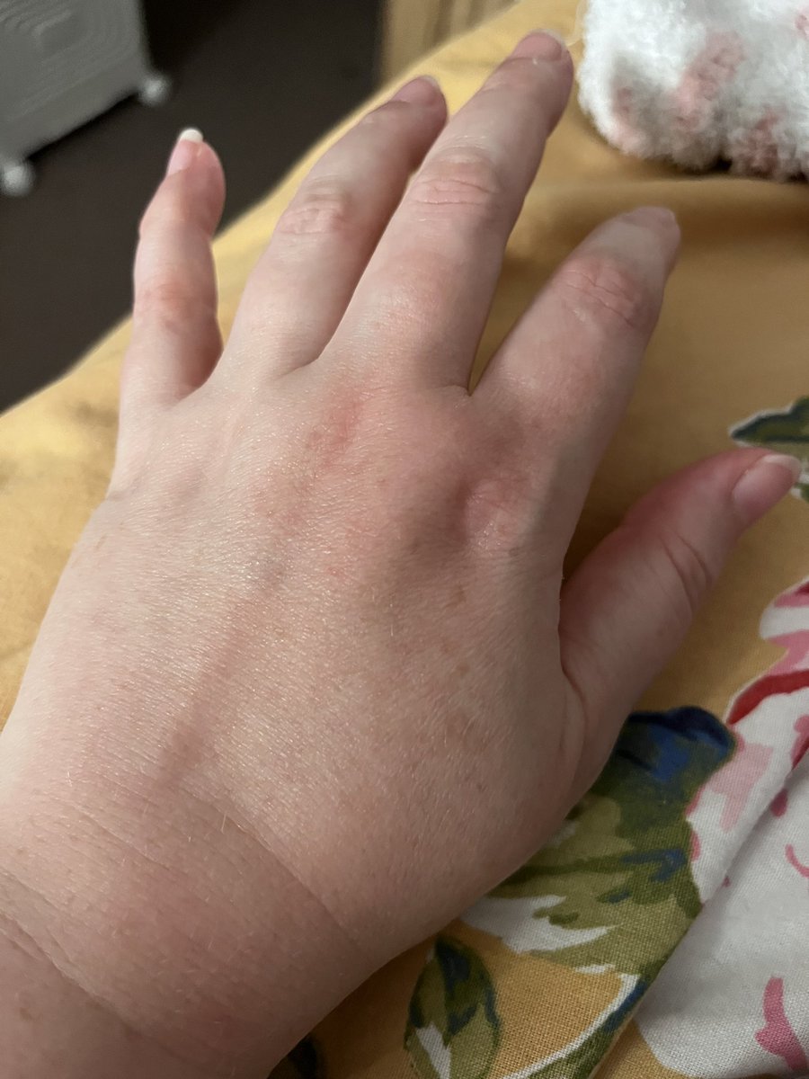 Rachelina16's tweet image. Wish I could stop my hands from swelling 😫 Always worse at night or first thing in the morning. Struggling to even use the kettle 😒 #mevalonatekinasedeficiency #autoinflammatoryaware