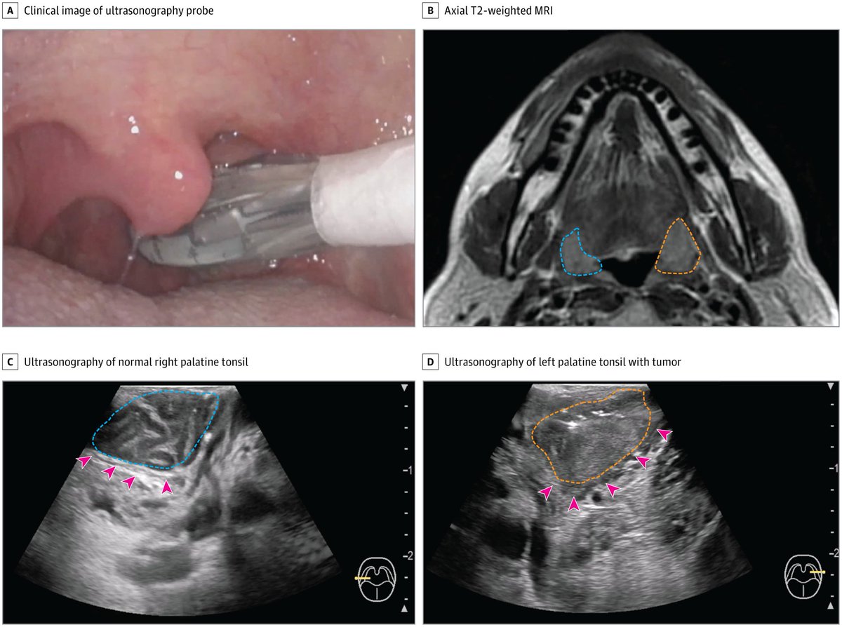 JAMAOto's tweet image. Transoral ultrasonography for evaluation of suspected oropharyngeal cancer provides higher diagnostic accuracy than MRI in the outpatient setting. ja.ma/46Txlpg