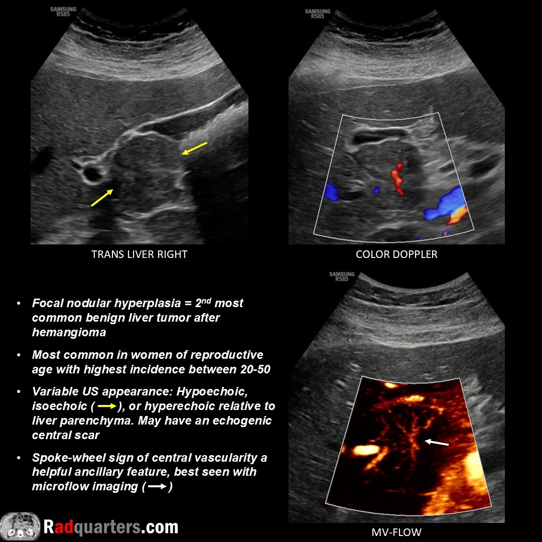 Radquarters's tweet image. 📽️ Watch video to learn more: youtu.be/zBesTEum5yM
#FOAMrad #FOAMed #usrad #radres #radtech #medstudent #radquarters @BostonImaging @SamsungHealth