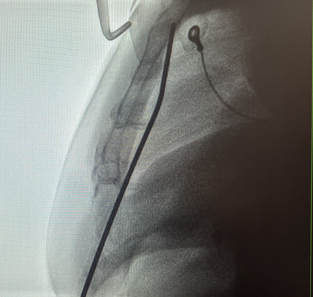 EPWaveDoc's tweet image. Successful implantation of EV-ICD #Medtronic Aurora in young patient with DCM with @RomainVergier and @PaulClaudien @ CHU #Martinique #Epeeps #Cardiology #cardiotwitter