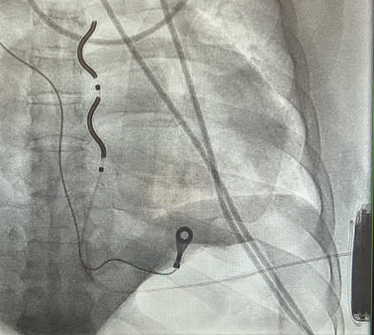 EPWaveDoc's tweet image. Successful implantation of EV-ICD #Medtronic Aurora in young patient with DCM with @RomainVergier and @PaulClaudien @ CHU #Martinique #Epeeps #Cardiology #cardiotwitter