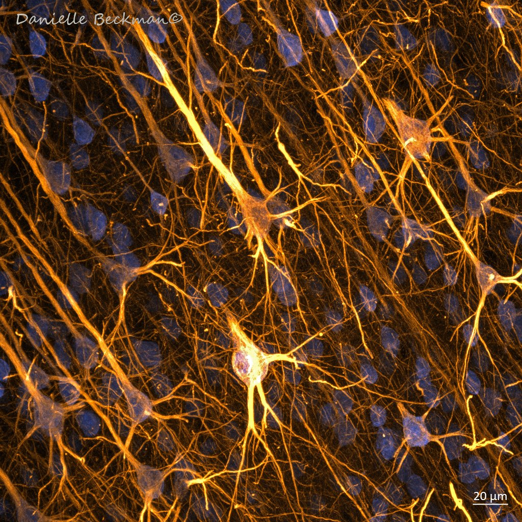 DaniBeckman's tweet image. Just pretty or useful? SMI32 🟡 targets a set of neurons more vulnerable to dementias. NeuN 🔵identifies most mature neurons in the cortex. Quantifying neurons identified by both markers can give you insights into neurodegenerative processes occurring in the 🧠#FluorescenceFriday