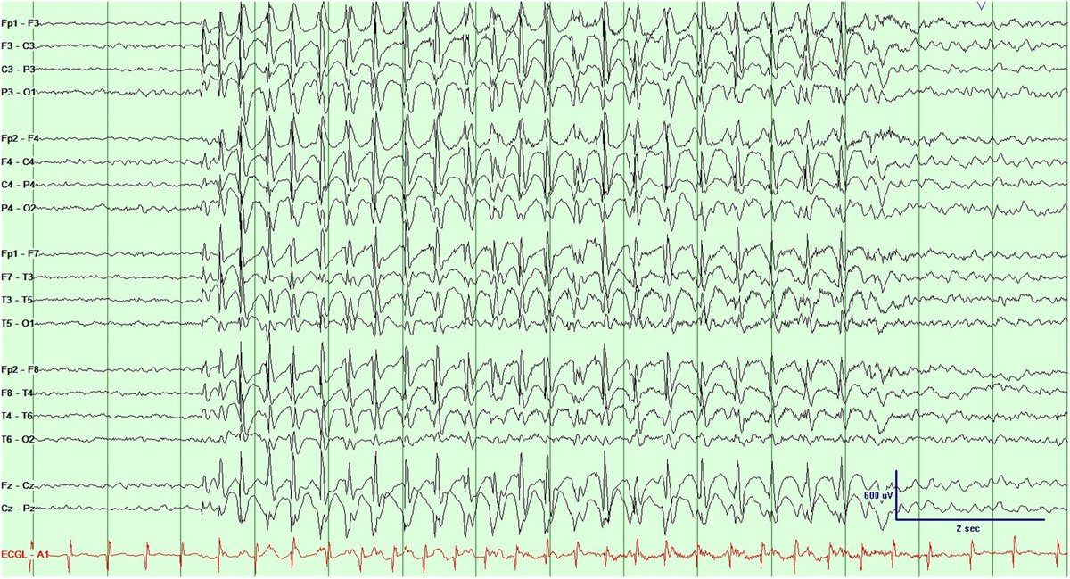AnnalsCNS's tweet photo. NEW visual diagnosis: Samuel Kamoroff et al. of @Nemours @MayoClinic present a 5-year-old girl with difficult-to-treat #epilepsy with developmental implications. Watch the video: https://t.co/t0JYDqiksz 

@WileyNeuro @md_galan https://t.co/qUNqD721z1