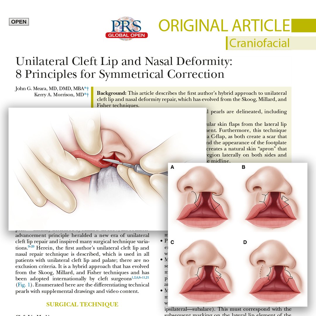 PRSGlobalOpen's tweet image. What are the principles and technical aspects in the first author’s evolved hybrid approach to unilateral #CleftLip and nasal deformity repair? Read, "Unilateral Cleft Lip and Nasal Deformity: 8 Principles for Symmetrical Correction," to find out: l8r.it/BHWs