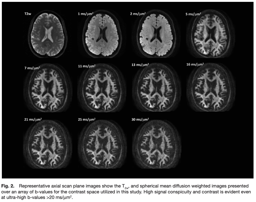 ImagingNeurosci's tweet image. New paper in Imaging Neuroscience by Nastaren Abad, Thomas K.F. Foo et al.:
Feasibility of brain intra-axonal microstructure imaging with ultrahigh B-encoding using MAGNUS ultra-high-performance gradients