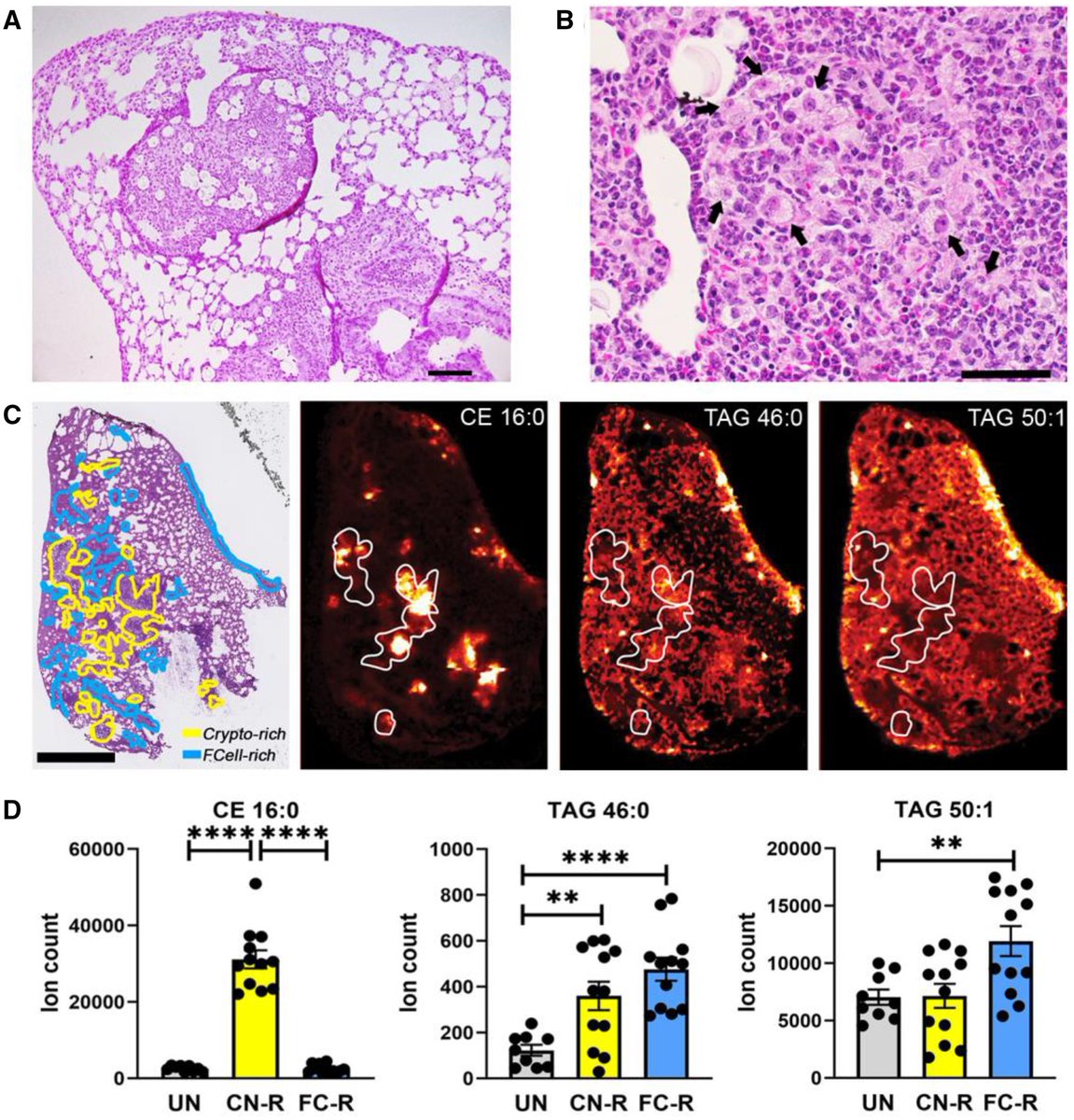 J_Immunol's tweet image. Foam cells are dysfunctional, lipid-laden macrophages. Data indicate that the events underlying foam cell formation are disease- and microenvironment-specific, opening new avenues for disease-specific biomedical research. Learn more: ow.ly/Ah0k50WlLiQ.