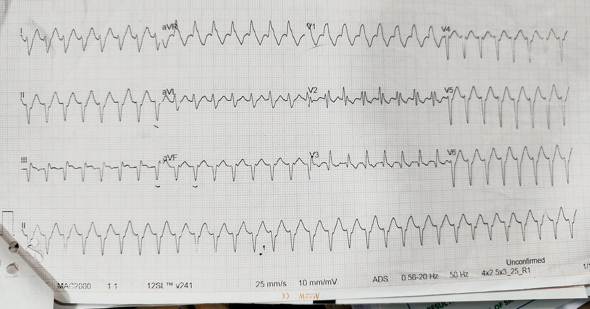 Young male with palpitations. Findings please. #CardioTwitter #MedTwitter