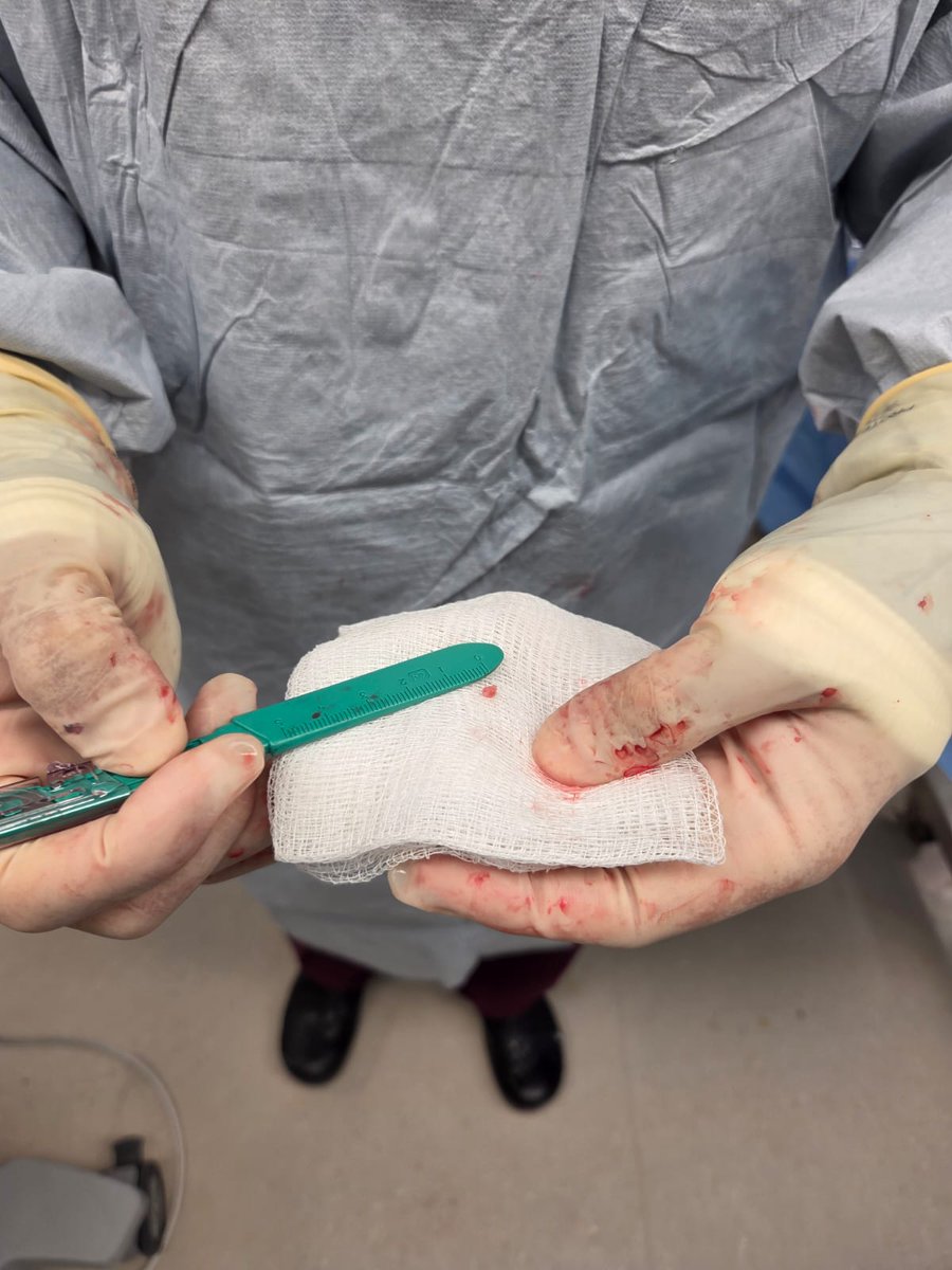 CerebrovascLab's tweet image. 📍Second enrollment at @uiowa for the ATHENA trial! Proud to contribute to advancing acute stroke care through this important multicenter effort.
@anaconda_biomed
#StrokeResearch #UIowa #ClinicalTrials #NeuroIntervention @marcriboj @ZanatyMario
@UIowaResearch @IowaNeurology…