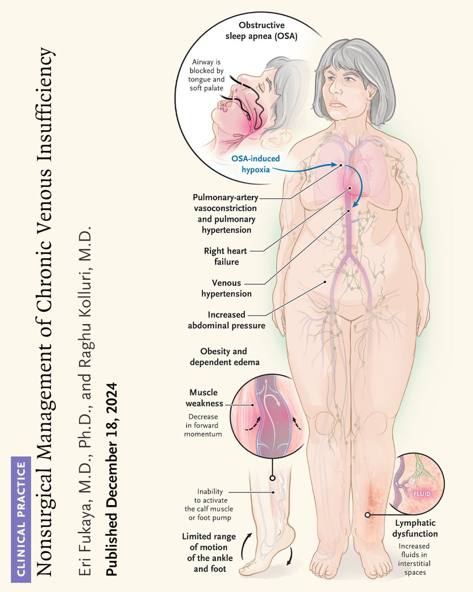 Venous insufficiency comprises a constellation of symptoms and clinical manifestations ranging from asymptomatic spider veins and varicose veins to venous leg ulcers. Chronic venous disease is often conflated with chronic venous insufficiency; however, by strict definition,
