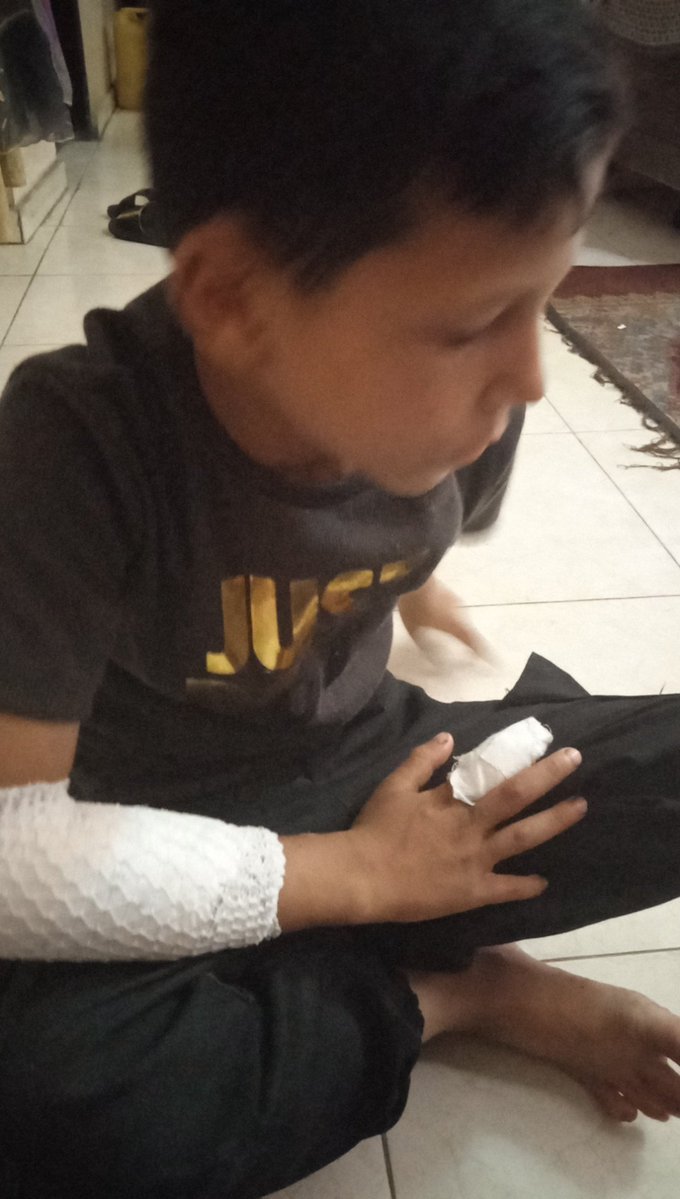 AsmBdwn37631's tweet image. gofund.me/4e9917c5
#VerifiedByRadioWatermelon
The burn on my little boy's hand is getting worse by the day, and I can't afford treatment. I'm asking for a generous donation of just $30 to provide the ointment he needs to ease his pain.
