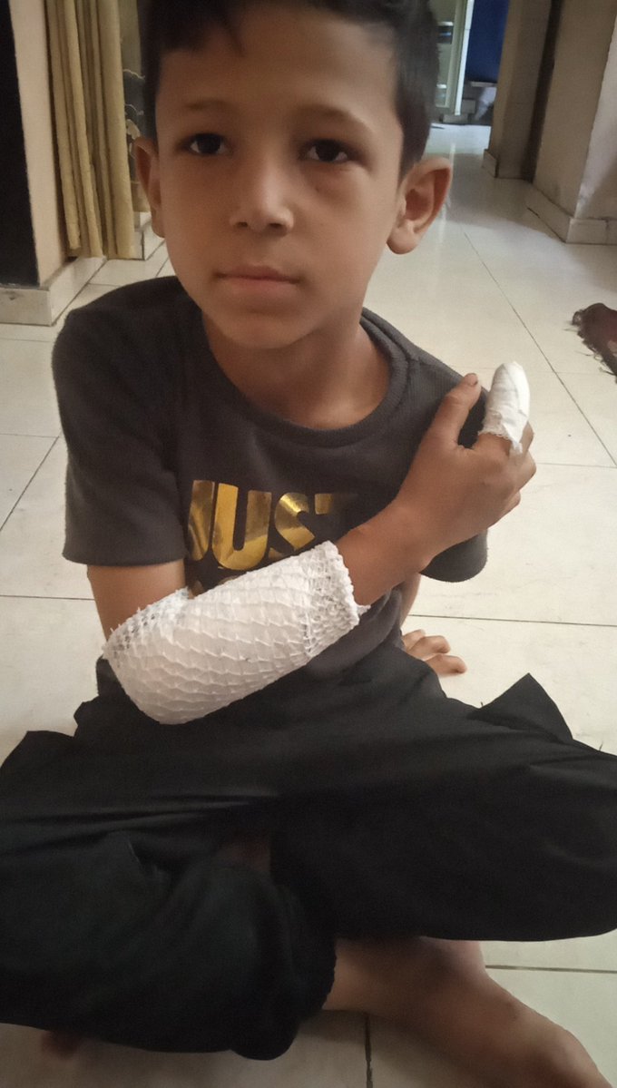 AsmBdwn37631's tweet image. gofund.me/4e9917c5
#VerifiedByRadioWatermelon
The burn on my little boy's hand is getting worse by the day, and I can't afford treatment. I'm asking for a generous donation of just $30 to provide the ointment he needs to ease his pain.