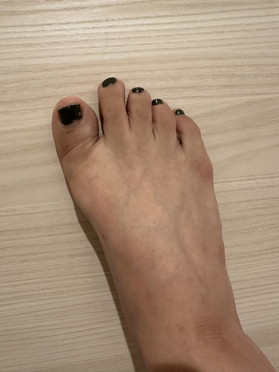 エスワンタイホウ
色素沈着経過観察19
2クール10日目

空腹だとムカムカするが吐き気はない
食べたら落ち着く
これかなりの太りそう😂

最初は色素沈着に怯えていましたが段々もうどうでも良くなってきた感もある…
あきらめ🥹
#抗がん剤
#エスワンタイホウ　#色素沈着
#乳がん　#ルミナールb