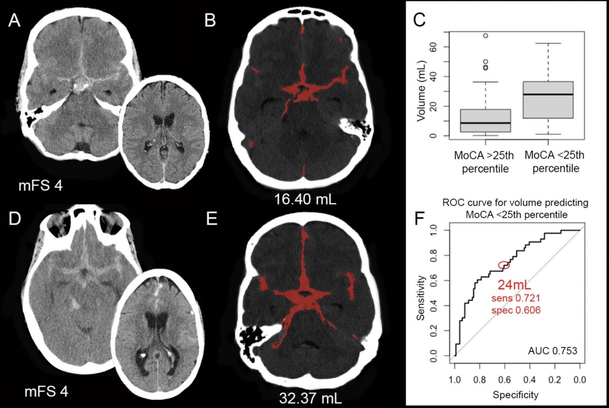 Elena Sagüés (@elena_sagues) on Twitter photo "Volume of aneurysmal subarachnoid hemorrhage and cognitive outcomes" <a href="/neurocritical/">Neurocritical Care Society</a>
doi.org/10.1007/s12028…
<a href="/esamaniego/">Edgar A Samaniego P</a> <a href="/CerebrovascLab/">Cerebrovascular & Neurointerventional Lab</a> <a href="/ZanatyMario/">Mario Zanaty</a> "Volume of aneurysmal subarachnoid hemorrhage and cognitive outcomes" <a href="/neurocritical/">Neurocritical Care Society</a>
doi.org/10.1007/s12028…
<a href="/esamaniego/">Edgar A Samaniego P</a> <a href="/CerebrovascLab/">Cerebrovascular & Neurointerventional Lab</a> <a href="/ZanatyMario/">Mario Zanaty</a>