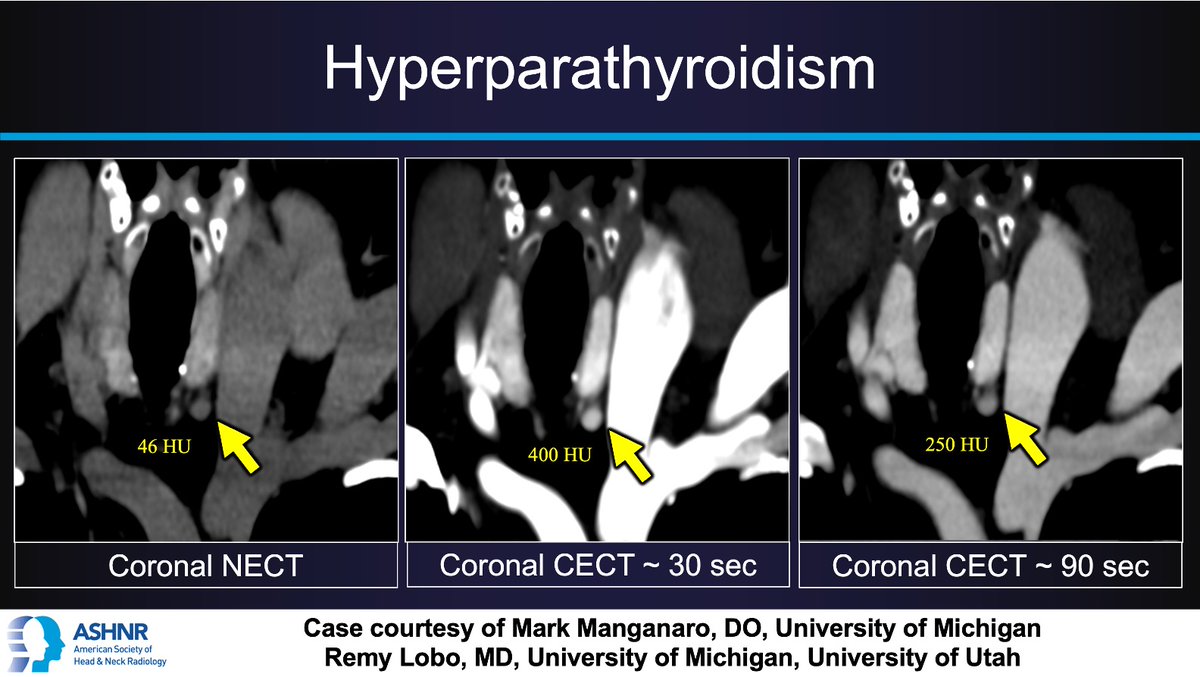 ASHNRSociety's tweet image. #ASHNRCOTW #305: ANSWER. Thx
@ilovemangos21 + @remyrlobo 4 case! #ASHNR25
@callyrobs @DShatzkes @CDP_Rad @rhwiggins
@nakoontz @KRileyMD @CMGlastonbury @tabby_kennedy @PhilipRChapman1 @cmtomblinson
@amyfjuliano @bpoliceni @MohitTCCNeuro @AshokSrini15 @KatieTraylorDO…