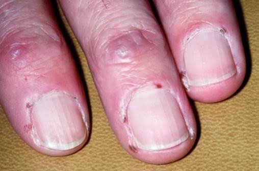 🧵 Nails in Rheumatology – Small Clues, Big Diagnoses

Think nails don’t matter? Think again.
Your patient’s fingertips may be screaming the diagnosis.

Let’s decode the key nail findings in rheumatology 🔍
#RheumTwitter #MedEd #DermTwitter <a href="/IhabFathiSulima/">Dr Ihab Suliman</a> <a href="/DrAkhilX/">Dr. Akhil 🇮🇳</a>