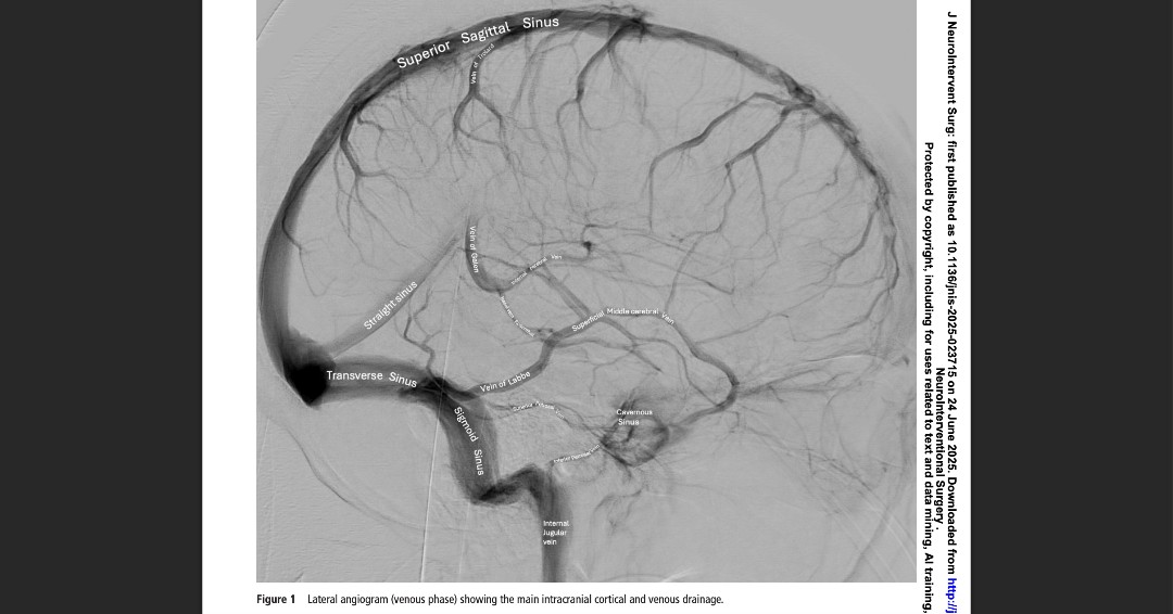 JNIS_BMJ's tweet image. Cerebral venography and venous manometry remain vital tools in neurovascular care, complementing non-invasive imaging like CT and MR venography. This review explores their evolving roles, key indications, and technical tips to optimize outcomes in cerebrovenous disease evaluation…