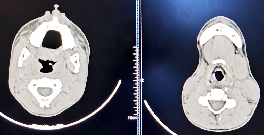 DeepakSudev's tweet photo. Post and Pre treatment CT scan for prevertbral infection with IV antibiotics in 13 year old boy presented with Torticollis https://t.co/6W8F6TgJDP