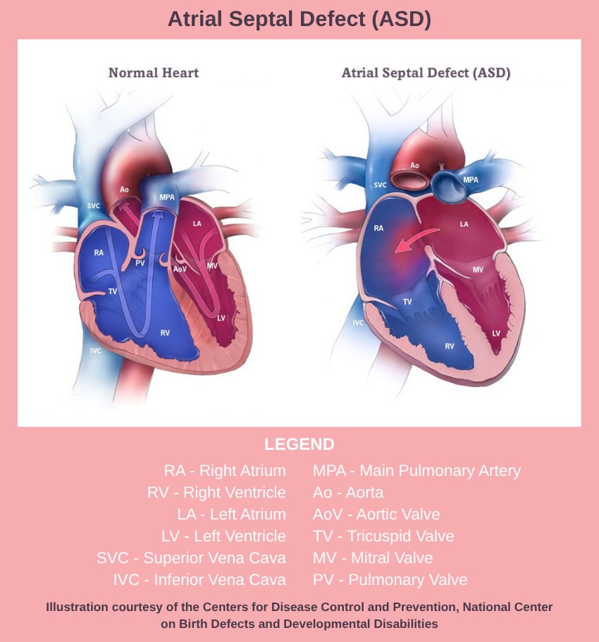 ACHA (@acha_heart) on Twitter photo Atrial septal defect is just one of ACHA's Q&As on specific CHDs that you can find on our website. Visit ow.ly/L58G50WrmlU to access all of our defect-specific Q&As. #AtrialSeptalDefect #CHD #ACHD #CHDAwareness #CHDCare4Life #ACHACares Atrial septal defect is just one of ACHA's Q&As on specific CHDs that you can find on our website. Visit ow.ly/L58G50WrmlU to access all of our defect-specific Q&As. #AtrialSeptalDefect #CHD #ACHD #CHDAwareness #CHDCare4Life #ACHACares