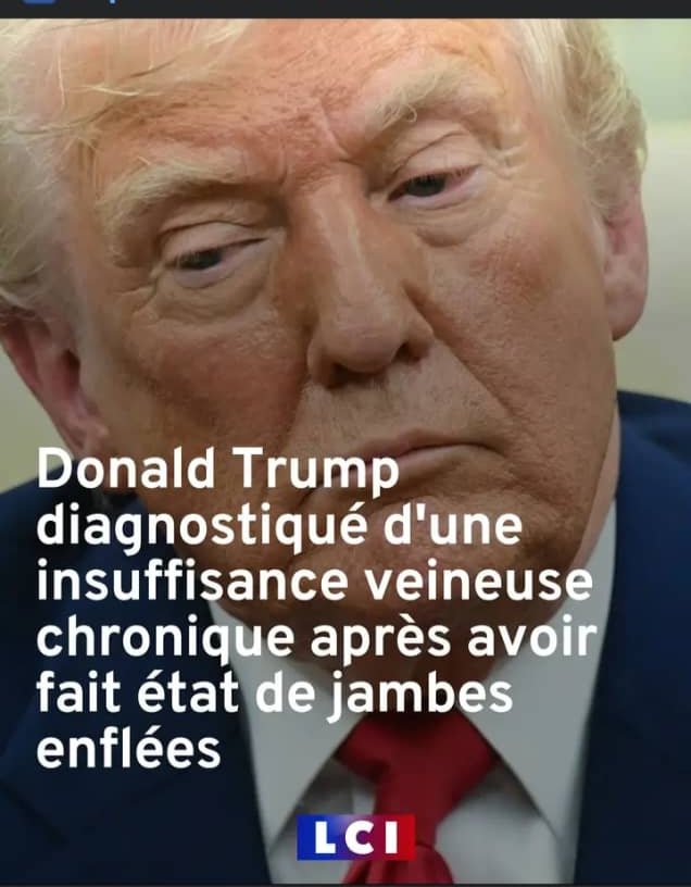 jean_lomanga's tweet photo. #RDC le #PR américain @DonaldTrump serait atteint de la maladie communément appelée #mbasu aprÚs avoir accepté le deal de beadage de nos minerais lui proposé par @fatshi13 , semble-t-il. Who's the next ? https://t.co/yvwGYpfILT
