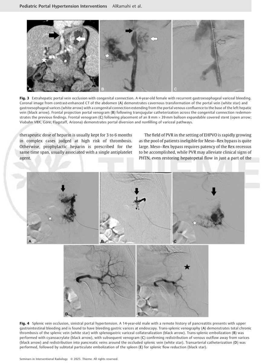 CHICKVIR's tweet image. This review highlights the challenges of managing pediatric portal hypertension and focuses on the role of Interventional Radiology in treating underlying vascular causes and secondary complications.
thieme-connect.com/products/ejour…
@JVIRmedia @SemInterventRad @cvirendo @USC