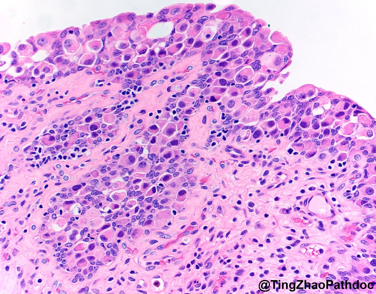 Ting Zhao, MD (@tingzhaopathdoc) on Twitter photo 81 y.o. M, cystectomy specimen. What is your diagnosis?
#PathTwitter
<a href="/MGBpathology/">Mass General Brigham Pathology</a> <a href="/MGHPathology/">MGH Pathology</a> 81 y.o. M, cystectomy specimen. What is your diagnosis?
#PathTwitter
<a href="/MGBpathology/">Mass General Brigham Pathology</a> <a href="/MGHPathology/">MGH Pathology</a>