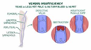 CoderJahangir's tweet image. Chronic venous insufficiency (CVI) happens when your leg veins become damaged and can’t work as they should. Normally, valves in your leg veins keep blood flowing back up to your heart. But CVI damages those valves, causing blood to pool in your legs..
M I:eliy.site/x6Msb