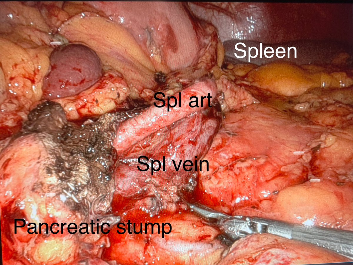 DrJashDatta's tweet image. Robotic 🤖spleen preserving distal pancreatectomy for proximal body WDG1 #PNET @SylvesterCancer. While this was long segment pancreas to dissect off art/vein (you can see spleen a MILE away) we should offer to pts w/ low risk tumors &favorable vascular anatomy *w/ pt permission