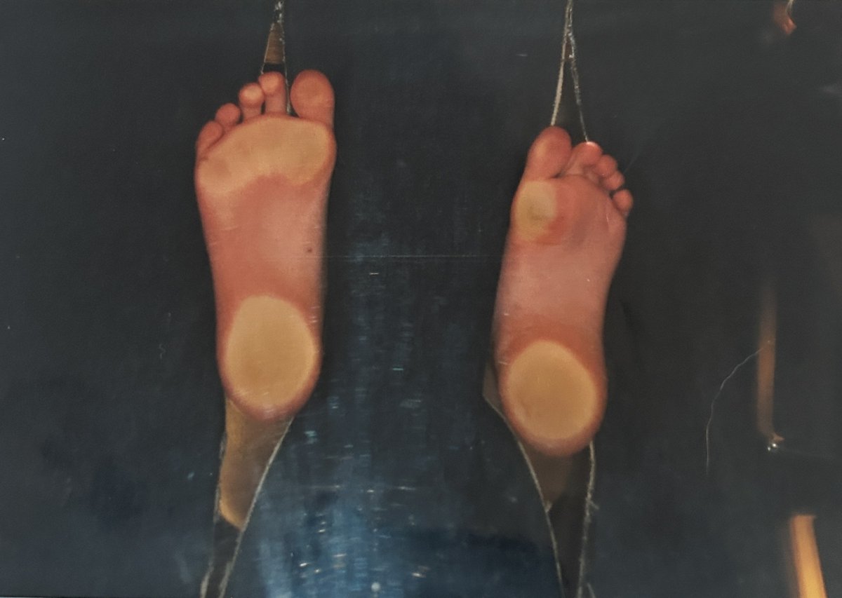 ShrinersChicago's tweet image. Vaughan, a former @shrinershosp patient born with a foot disorder known as vertical talus, received orthopedic care and multiple surgeries at @shrinersSLC. Now, he’s running in the 2025 @CHIMarathon. Help Team Shriners go the distance. Donate today ow.ly/3QiY50WrkgN.