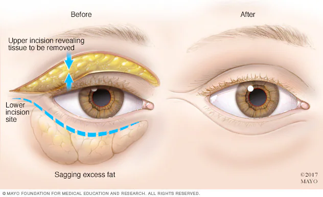 NatEyeInstitute's tweet image. Are drooping eyelids affecting your vision? Blepharoplasty (eyelid surgery) can help improve vision by removing excess skin. Learn more about when it’s recommended & what to expect with this article from @MayoClinic:
brnw.ch/21wUg6B
#Blepharoplasty #EyelidSurgery