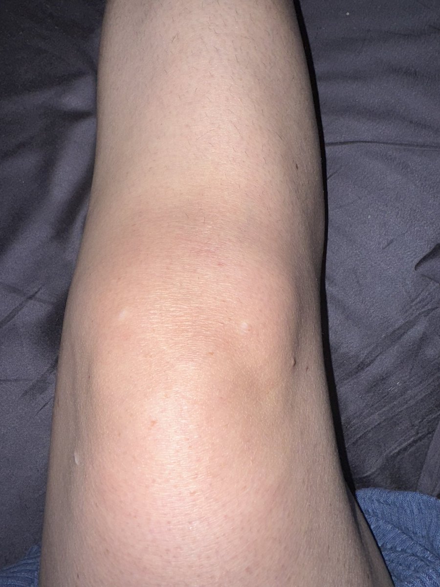 I wanna be a badass so bad but a tree root took me and this fuck ass knee out in 0.3 seconds 😭