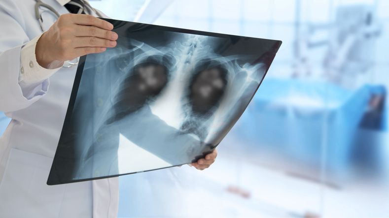 Lung_Cancers's tweet image. 🫁 Does savolitinib plus osimertinib improve survival in patients with MET-amplification EGFR-mutated NSCLC compared with chemotherapy?
💡 A recent study presented at #ASCO25 by a team of researchers from China addressed the question.
➡️ Learn more: buff.ly/PN6pbRL