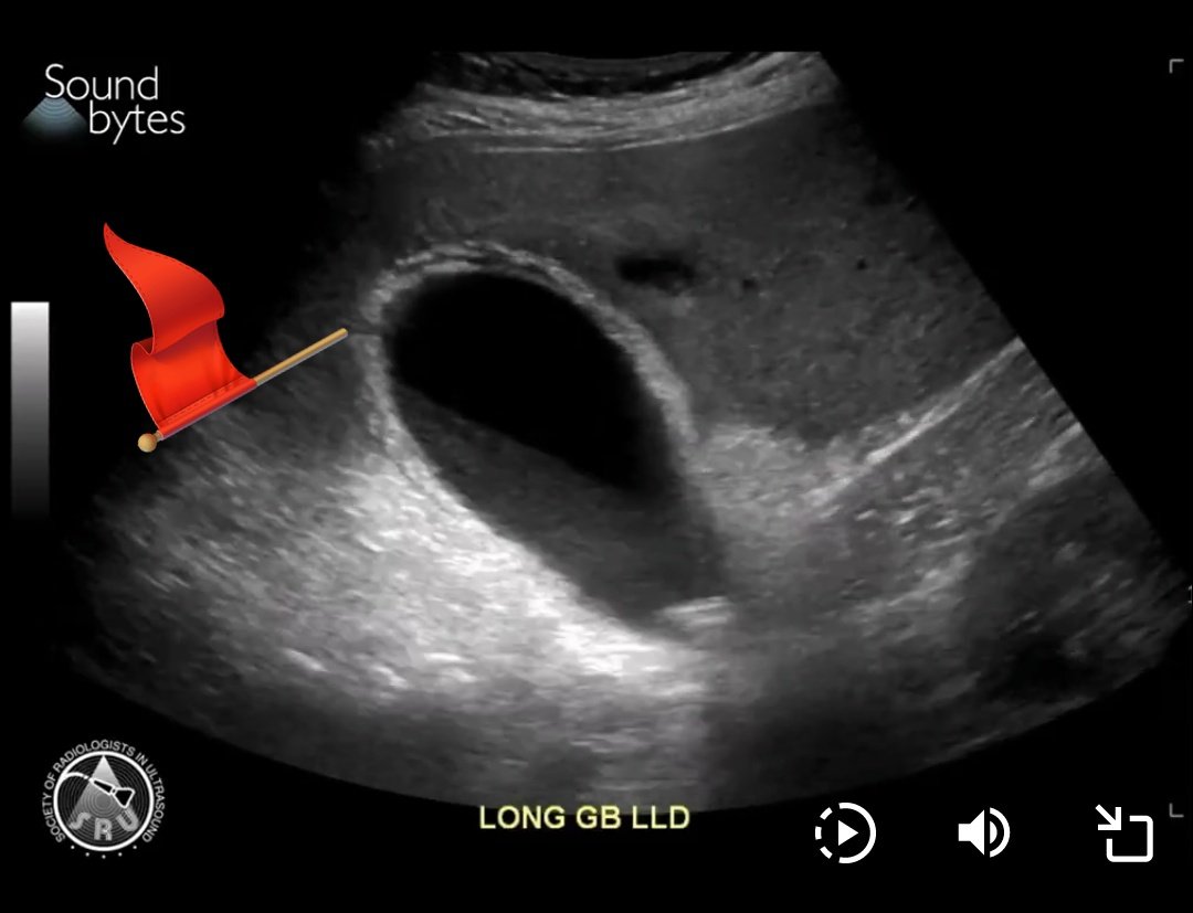 Gallbladder perforation. 
Flag points at the wall discontinuity.