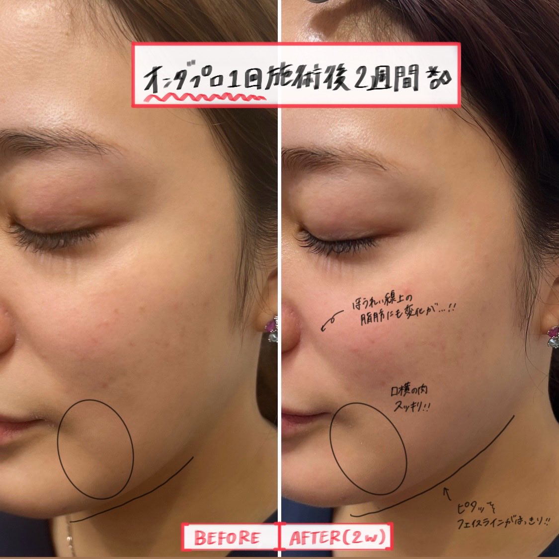 オンダプロによる施術の経過💭/ オンダリフト（オンダプロ）1回施術後2