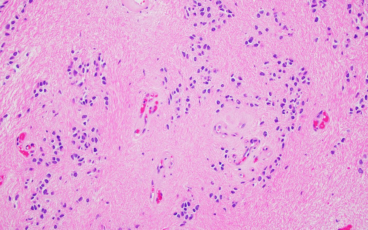 Jared T. Ahrendsen MD, PhD (AP/NP/FP) (@jaredahrendsen) on Twitter photo You don’t need special stains or fancy molecular testing to diagnose this #brain #tumor, located in the fourth ventricle. Flex your histology skills and tell me what you see! <a href="/NU_Pathology/">Northwestern Pathology</a> #neuropath 🧠🔬 You don’t need special stains or fancy molecular testing to diagnose this #brain #tumor, located in the fourth ventricle. Flex your histology skills and tell me what you see! <a href="/NU_Pathology/">Northwestern Pathology</a> #neuropath 🧠🔬