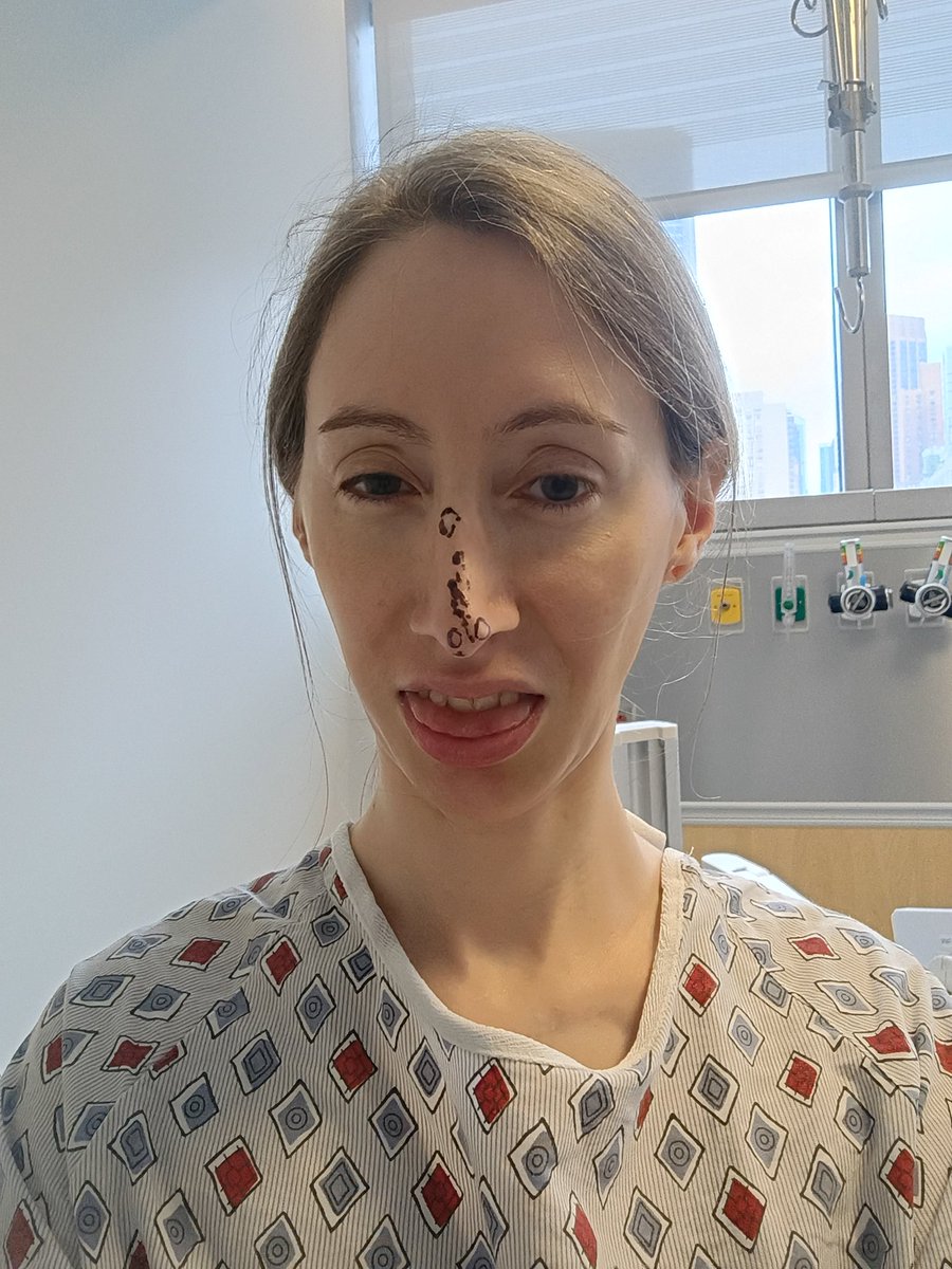 ScarsUnseen24's tweet image. Goofy pre-op picture. #deviatedseptum #birthdefect #stupidnose