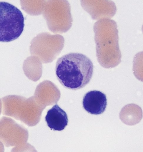 Nourhan Ibrahim (@nourhan_path22) on Twitter photo 2 Aur rods hanging in a mature myelocyte!! #MorphologyMagic🤩 2 Aur rods hanging in a mature myelocyte!! #MorphologyMagic🤩