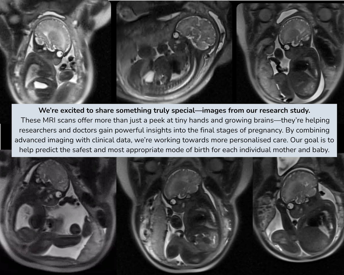 miBirth Study tweet media