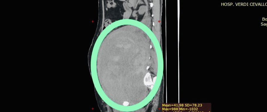 #ElNuevoEcuador | Le retiran 10 litros de sangre de un hematoma gigante 

Un equipo multidisciplinario de especialistas del <a href="/HospitalVerdi/">Hospital Verdi 🇪🇨</a> retiró con éxito un hematoma retroperitoneal gigante que acumulaba la asombrosa cantidad de 10 litros de sangre. 1/8