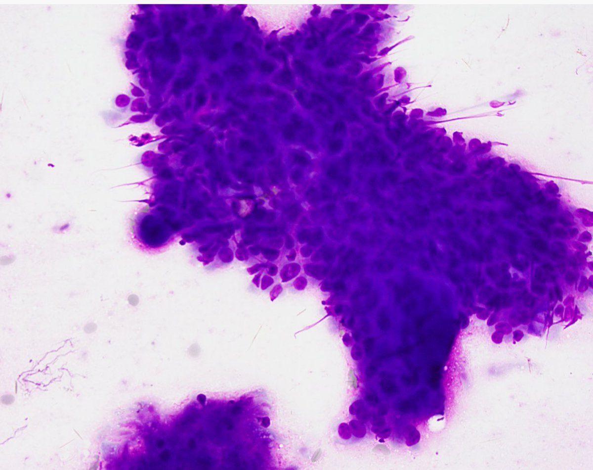 First week down on FNA clinic service at MGH! I couldn’t let it pass without sharing a special moment—my first US-guided FNA 😄
Huge thanks to my teacher of the week, Dr. Amy Ly for guidance! Check out my slide do you think it's good enough to diagnose this neck mass? 😉#CytoPath