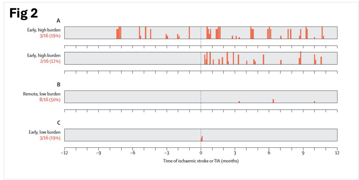 SposatoL's tweet image. ๐ง Great paper on BNP and timing of AFDAS diagnosis
๐Ref 1
๐ 374 #stroke pt w/o known #Afib, but AFDAS detected on cardiac monitoring (BIOSIGNAL & GRAZ cohorts)
๐ Inhospital AFDAS (72%):
๐งช NT-proBNP at admission predicts in-hospital AFDAS
โช๏ธCutoff: 505 pg/mL โ AUC 0.83โฆ