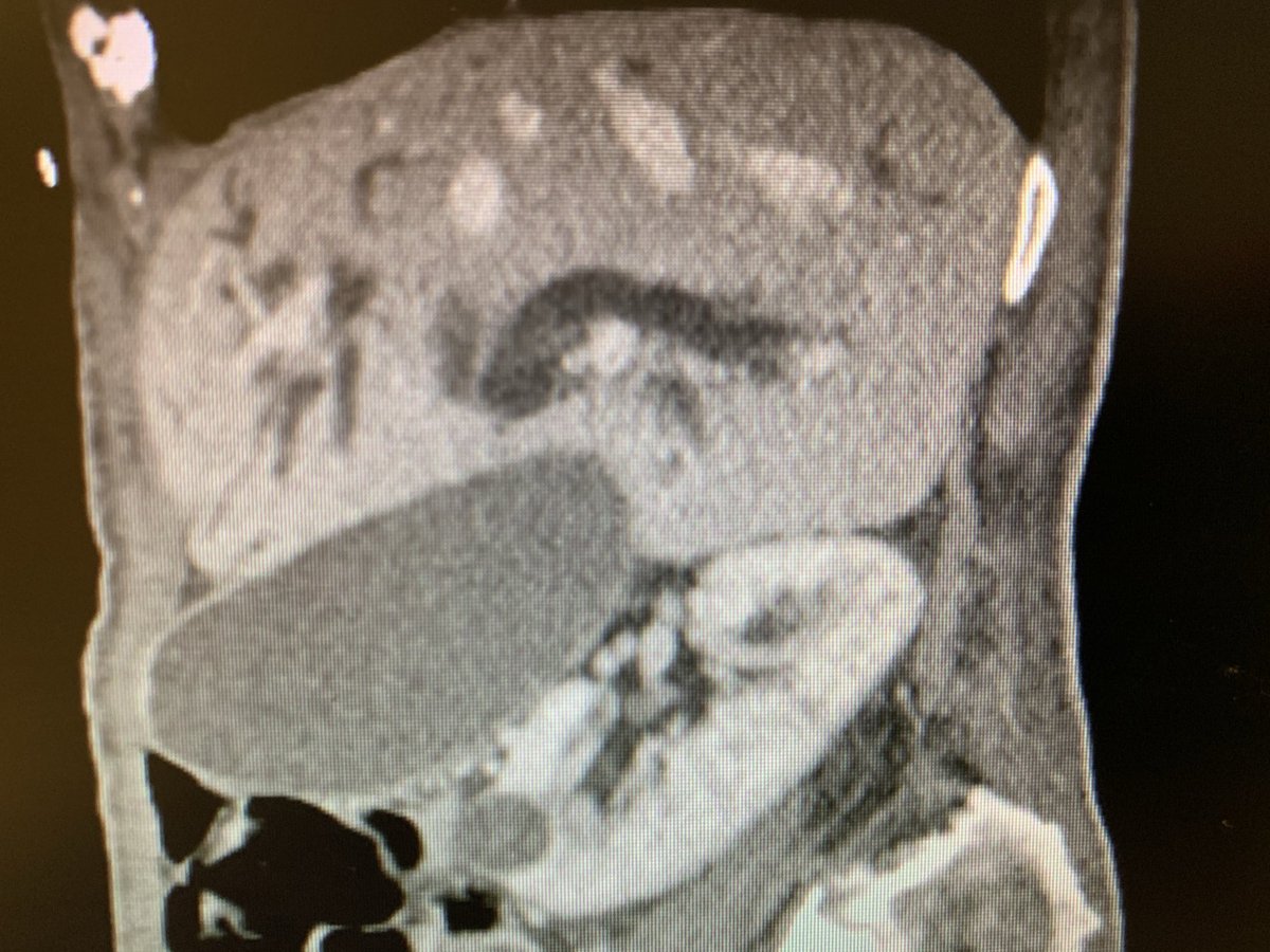 Here’s a sagittal image of a physical diagnosis finding. What is it? #MedTwitter #MedStudentTwitter #PhysicalDiagnosis ⁦<a href="/AHNIMres/">AHNIMres</a>⁩