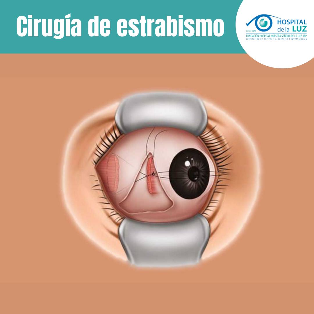 ¿En qué consiste la operación de estrabismo?

Con el fin de restablecer un correcto alineamiento de la mirada, el cirujano refuerza, debilita o recoloca los músculos extraoculares que rodean los ojos y controlan su movimiento.
