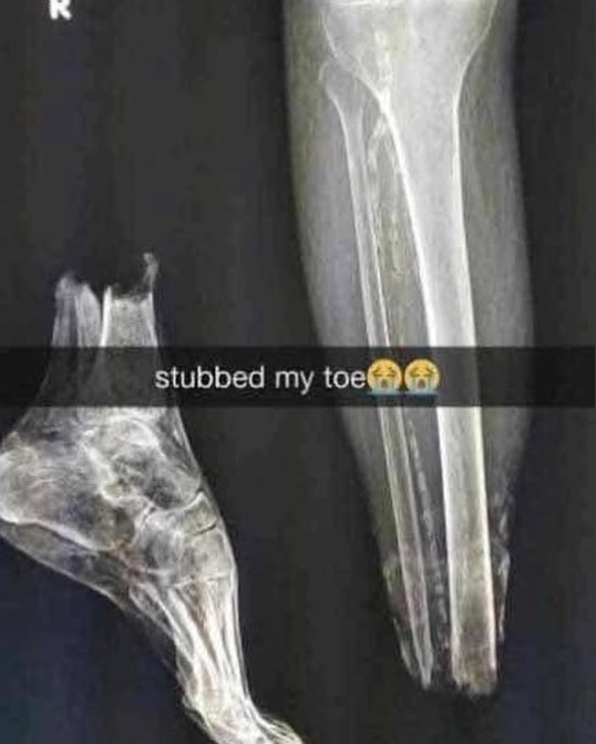 ashwr1dd's tweet photo. @sumyeett yea same js stubbed by toe… nth much all g https://t.co/AmqFgmNk2Z
