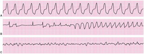 Bartosz Hudzik MD PhD FESC FACC (@bartoszhudzik) on Twitter photo Predictors of 1️⃣st major arrhythmic event in non-dilated LV #cardiomyopathy: male sex, #NSVT, #LVEF<4️⃣5️⃣%, #LGE, high-risk genotypes & myocardial inflammation #arrhythmia #CardioTwitter #EPeeps 👉 bit.ly/44Ww4LJ <a href="/ESC_Journals/">European Society of Cardiology Journals</a> <a href="/GiovanniPeretto/">Giovanni Peretto</a> <a href="/drjohnm/">John Mandrola, MD</a> <a href="/mmamas1973/">Mamas A. Mamas</a> Predictors of 1️⃣st major arrhythmic event in non-dilated LV #cardiomyopathy: male sex, #NSVT, #LVEF<4️⃣5️⃣%, #LGE, high-risk genotypes & myocardial inflammation #arrhythmia #CardioTwitter #EPeeps 👉 bit.ly/44Ww4LJ <a href="/ESC_Journals/">European Society of Cardiology Journals</a> <a href="/GiovanniPeretto/">Giovanni Peretto</a> <a href="/drjohnm/">John Mandrola, MD</a> <a href="/mmamas1973/">Mamas A. Mamas</a>
