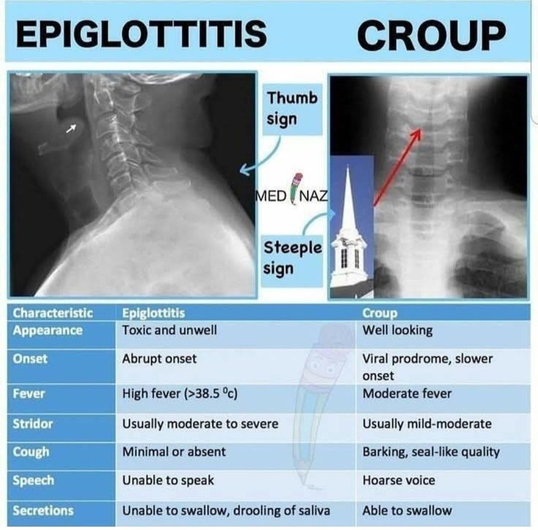 drsthanus's tweet photo. Epiglottitis vs Croup...

https://t.co/jPdD4XB25N https://t.co/A6fByCmHsj